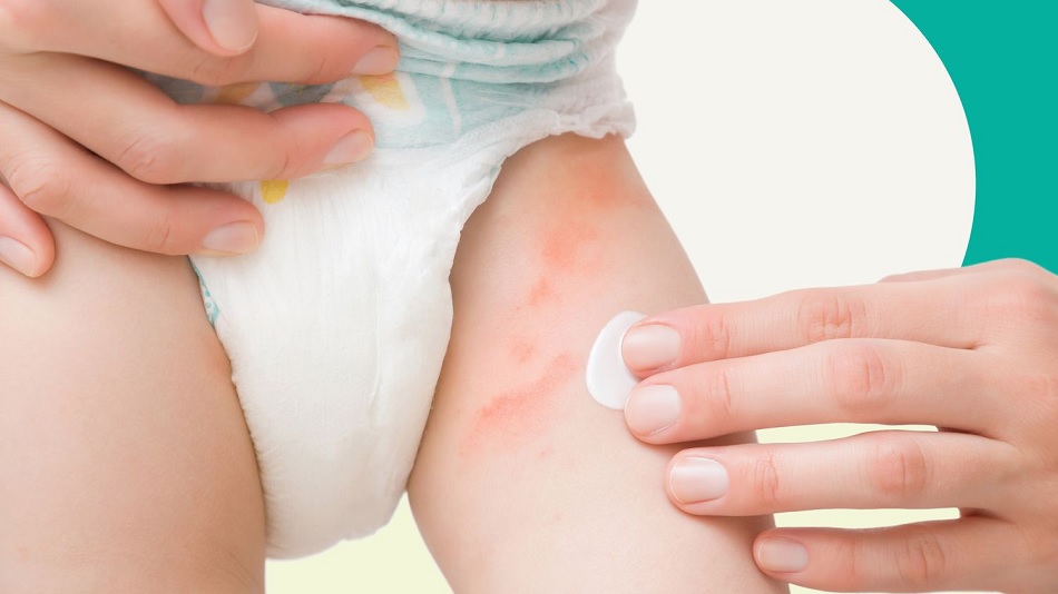 bỉm quần có bị hăm